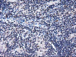 FAM40A Antibody - IHC of paraffin-embedded Human lymphoma tissue using anti-FAM40A mouse monoclonal antibody.