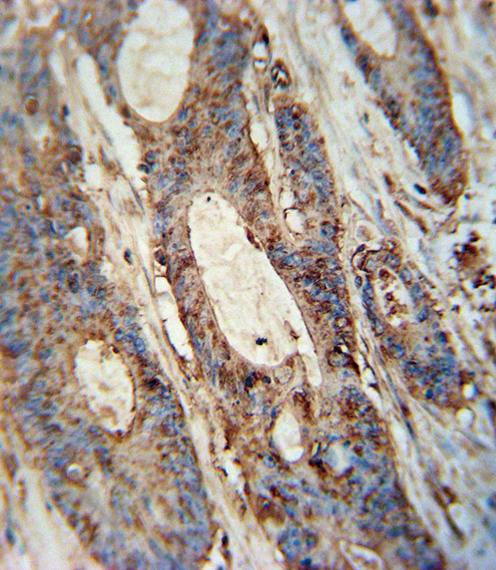 FAM46A Antibody - FAM46A antibody immunohistochemistry of formalin-fixed and paraffin-embedded human colon carcinoma followed by peroxidase-conjugated secondary antibody and DAB staining.