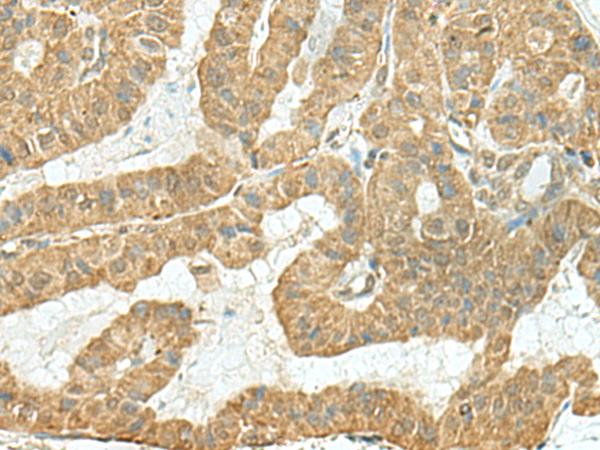 FAM46C Antibody - Immunohistochemistry of paraffin-embedded Human thyroid cancer tissue  using TENT5C Polyclonal Antibody at dilution of 1:110(×200)