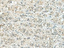 FAM46C Antibody - Immunohistochemistry of paraffin-embedded Human liver cancer tissue  using TENT5C Polyclonal Antibody at dilution of 1:110(×200)