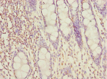 FAM48A / P38IP Antibody - Immunohistochemistry of paraffin-embedded human rectal cancer at dilution 1:100
