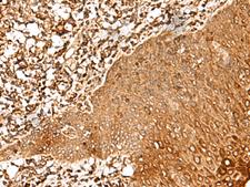 FAM50A Antibody - Immunohistochemistry of paraffin-embedded Human esophagus cancer tissue  using FAM50A Polyclonal Antibody at dilution of 1:25(×200)