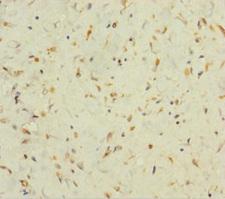 FAM60A Antibody - Immunohistochemistry of paraffin-embedded human colon cancer using FAM60A Antibody at dilution of 1:100