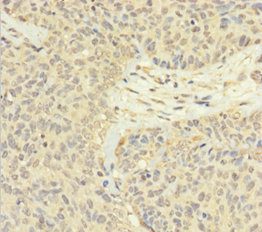 FAM60A Antibody - Immunohistochemistry of paraffin-embedded human ovarian cancer using FAM60A Antibody at dilution of 1:100