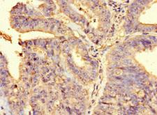 FAM65B / DIFF48 Antibody - Immunohistochemistry of paraffin-embedded human endometrial carcinoma at dilution 1:100