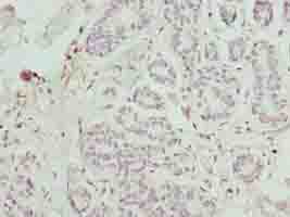 FAM71F1 Antibody - Immunohistochemistry of paraffin-embedded human breast cancer using antibody at dilution of 1:100.