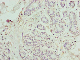 FAM71F1 Antibody - Immunohistochemistry of paraffin-embedded human breast cancer using FAM71F1 Antibody at dilution of 1:100