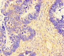 FAM71F2 Antibody - Immunohistochemistry of paraffin-embedded human ovarian cancer using FAM71F2 Antibody at dilution of 1:100