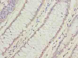 FAM78A Antibody - Immunohistochemistry of paraffin-embedded human colon cancer using antibody at dilution of 1:100.