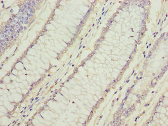 FAM78A Antibody - Immunohistochemistry of paraffin-embedded human colon cancer using FAM78A Antibody at dilution of 1:100