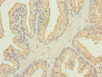 FAM78A Antibody - Immunohistochemistry of paraffin-embedded human prostate cancer using FAM78A Antibody at dilution of 1:100