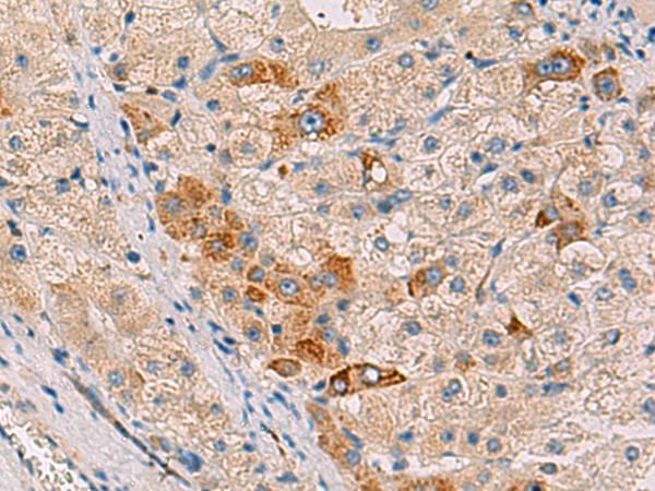 FAM82A1 Antibody - Immunohistochemistry of paraffin-embedded Human liver cancer tissue  using RMDN2 Polyclonal Antibody at dilution of 1:50(×200)