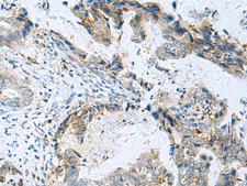 FAM82A1 Antibody - Immunohistochemistry of paraffin-embedded Human cervical cancer tissue  using RMDN2 Polyclonal Antibody at dilution of 1:70(×200)