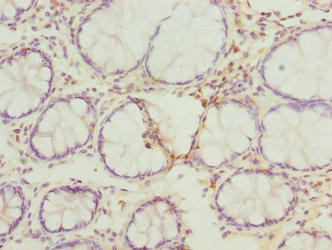 FAM82B Antibody - Immunohistochemistry of paraffin-embedded human colon cancer using RMDN1 Antibody at dilution of 1:100