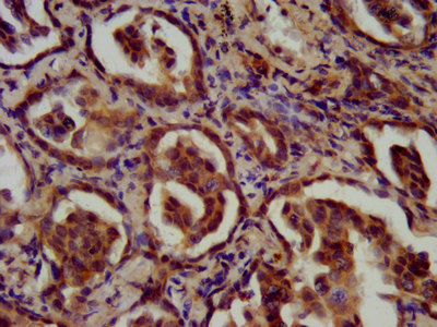 FAM84A Antibody - Immunohistochemistry image at a dilution of 1:200 and staining in paraffin-embedded human liver cancer performed on a Leica BondTM system. After dewaxing and hydration, antigen retrieval was mediated by high pressure in a citrate buffer (pH 6.0) . Section was blocked with 10% normal goat serum 30min at RT. Then primary antibody (1% BSA) was incubated at 4 °C overnight. The primary is detected by a biotinylated secondary antibody and visualized using an HRP conjugated SP system.