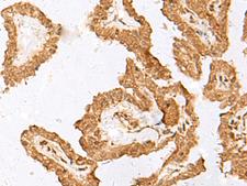 FAM84A Antibody - Immunohistochemistry of paraffin-embedded Human thyroid cancer tissue  using FAM84A Polyclonal Antibody at dilution of 1:35(×200)