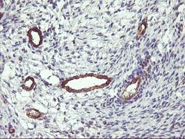 FAM84B Antibody - IHC of paraffin-embedded Adenocarcinoma of Human ovary tissue using anti-FAM84B mouse monoclonal antibody.