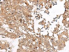 FAM84B Antibody - Immunohistochemistry of paraffin-embedded Human lung cancer tissue  using FAM84B Polyclonal Antibody at dilution of 1:45(×200)
