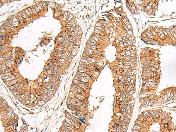 FAM84B Antibody - Immunohistochemistry of paraffin-embedded Human colorectal cancer tissue  using FAM84B Polyclonal Antibody at dilution of 1:45(×200)