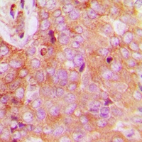 FAM84B Antibody - Immunohistochemical analysis of FAM84B staining in human breast cancer formalin fixed paraffin embedded tissue section. The section was pre-treated using heat mediated antigen retrieval with sodium citrate buffer (pH 6.0). The section was then incubated with the antibody at room temperature and detected with HRP and DAB as chromogen. The section was then counterstained with hematoxylin and mounted with DPX.