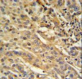 FAM91A1 Antibody - F91A1 Antibody IHC of formalin-fixed and paraffin-embedded human cervix carcinoma followed by peroxidase-conjugated secondary antibody and DAB staining.