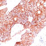 FAM98A Antibody - Immunohistochemistry of paraffin-embedded Human colon carcinoma using FAM98A Polyclonal Antibody at dilution of 1:100 (40x lens).