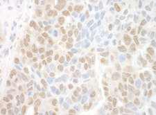 FAN1 Antibody - Detection of Human MTMR15 by Immunohistochemistry. Sample: FFPE section of human ovarian carcinoma. Antibody: Affinity purified rabbit anti-MTMR15 used at a dilution of 1:250.