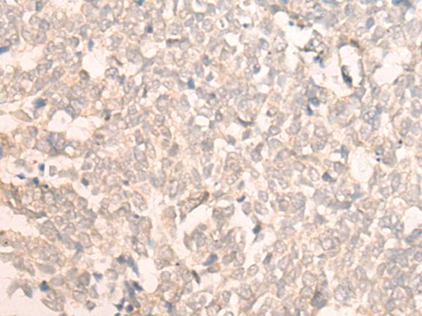 FAN1 Antibody - Immunohistochemistry of paraffin-embedded Human lung cancer tissue  using FAN1 Polyclonal Antibody at dilution of 1:30(×200)