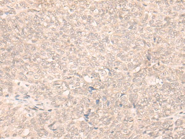 FAN1 Antibody - Immunohistochemistry of paraffin-embedded Human ovarian cancer tissue  using FAN1 Polyclonal Antibody at dilution of 1:30(×200)