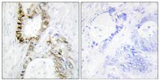 FANCA Antibody - Peptide - + Immunohistochemistry analysis of paraffin-embedded human colon carcinoma tissue using FANCA antibody.