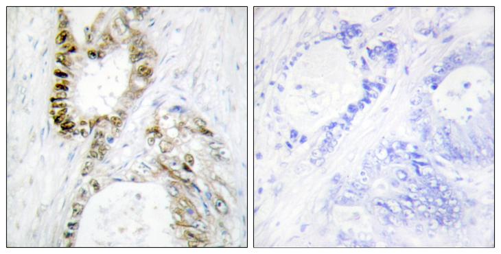 FANCA Antibody - Peptide - + Immunohistochemistry analysis of paraffin-embedded human colon carcinoma tissue using FANCA antibody.