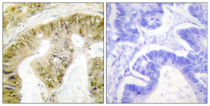 FANCA Antibody - Immunohistochemistry analysis of paraffin-embedded human colon carcinoma, using FANCA (Phospho-Ser1149) Antibody. The picture on the right is blocked with the phospho peptide.