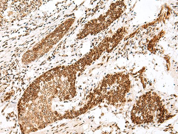 FANCB / FAB Antibody - Immunohistochemistry of paraffin-embedded Human esophagus cancer tissue  using FANCB Polyclonal Antibody at dilution of 1:25(×200)