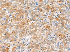 FANCB / FAB Antibody - Immunohistochemistry of paraffin-embedded Human cervical cancer tissue  using FANCB Polyclonal Antibody at dilution of 1:60(×200)