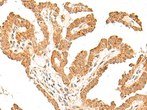 FANCB / FAB Antibody - Immunohistochemistry of paraffin-embedded Human thyroid cancer tissue  using FANCB Polyclonal Antibody at dilution of 1:60(×200)