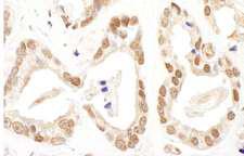 FANCD2 Antibody - Detection of Human FANCD2 by Immunohistochemistry. Sample: FFPE section of human prostate carcinoma. Antibody: Affinity purified rabbit anti-FANCD2 used at a dilution of 1:200 (1 Detection: DAB.