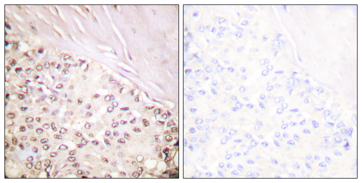 FANCD2 Antibody - Immunohistochemistry analysis of paraffin-embedded human breast carcinoma tissue, using FANCD2 Antibody. The picture on the right is blocked with the synthesized peptide.