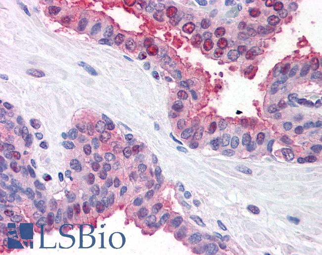 FANCD2 Antibody - Human Prostate (formalin-fixed, paraffin-embedded) stained with FANCD2 antibody LS-B493 at 2.5-5 ug/ml followed by biotinylated goat anti-rabbit IgG secondary antibody, alkaline phosphatase-streptavidin and chromogen.  This image was taken for the unconjugated form of this product. Other forms have not been tested.