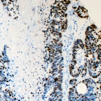 FANCD2 Antibody - Immunohistochemical analysis of FANCD2 staining in human colon cancer formalin fixed paraffin embedded tissue section. The section was pre-treated using heat mediated antigen retrieval with sodium citrate buffer (pH 6.0). The section was then incubated with the antibody at room temperature and detected using an HRP polymer system. DAB was used as the chromogen. The section was then counterstained with hematoxylin and mounted with DPX.