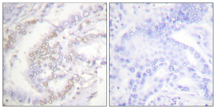 FANCD2 Antibody - Immunohistochemistry analysis of paraffin-embedded human lung carcinoma, using FANCD2 (Phospho-Ser222) Antibody. The picture on the right is blocked with the phospho peptide.