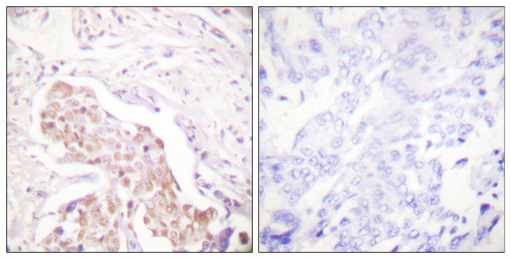 FANCD2 Antibody - P-peptide - + Immunohistochemical analysis of paraffin-embedded human lung carcinoma tissue using FANCD2 (Phospho-Ser222) antibody.