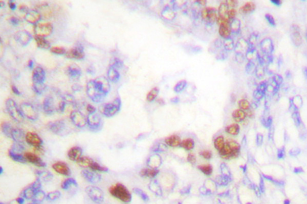 FANCD2 Antibody - IHC of FANCD2 (P216) pAb in paraffin-embedded human breast carcinoma tissue.