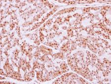 FANCE Antibody - IHC of paraffin-embedded Breast ca, using FANCE antibody at 1:250 dilution.