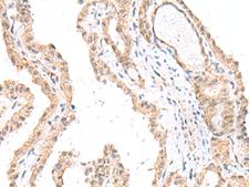 FANCE Antibody - Immunohistochemistry of paraffin-embedded Human thyroid cancer tissue  using FANCE Polyclonal Antibody at dilution of 1:50(×200)