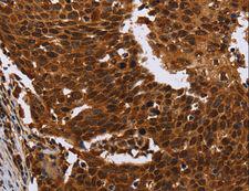 FANCF Antibody - Immunohistochemistry of paraffin-embedded Human colon cancer using FANCF Polyclonal Antibody at dilution of 1:60.