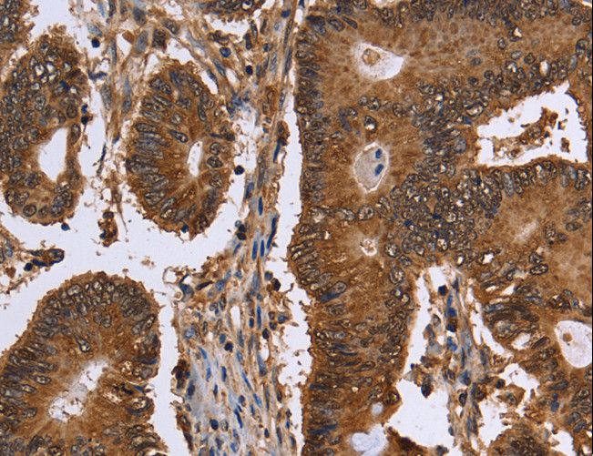 FANCF Antibody - Immunohistochemistry of paraffin-embedded Human colon cancer using FANCF Polyclonal Antibody at dilution of 1:60.