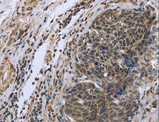 FANCG Antibody - Immunohistochemistry of paraffin-embedded Human ovarian cancer using FANCG Polyclonal Antibody at dilution of 1:50.