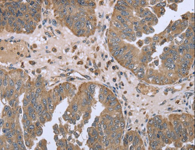 FANCG Antibody - Immunohistochemistry of paraffin-embedded Human ovarian cancer using FANCG Polyclonal Antibody at dilution of 1:50.