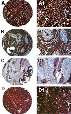 FAP-1 / PTPN13 Antibody - Immunohistochemistry of FAP-1 in formalin-fixed, paraffin embedded ovarian carcinoma cores from a tissue microarray using Polyclonal Antibody to FAP-1 at 1:2000. A-D, samples are from four different patients. A1-D1 are high magnification images from A-D, respectively. Hematoxylin-Eosin counterstain.
