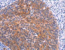 FAP-1 / PTPN13 Antibody - Immunohistochemistry of paraffin-embedded Human thyroid cancer using PTPN13 Polyclonal Antibody at dilution of 1:30.